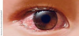 Información sobre conjuntivitis alérgica